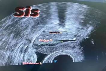 سونوگرافی با کنتراست (SIS)؛ کلید طلایی شناسایی ضایعات رحمی و افزایش موفقیت IVF
